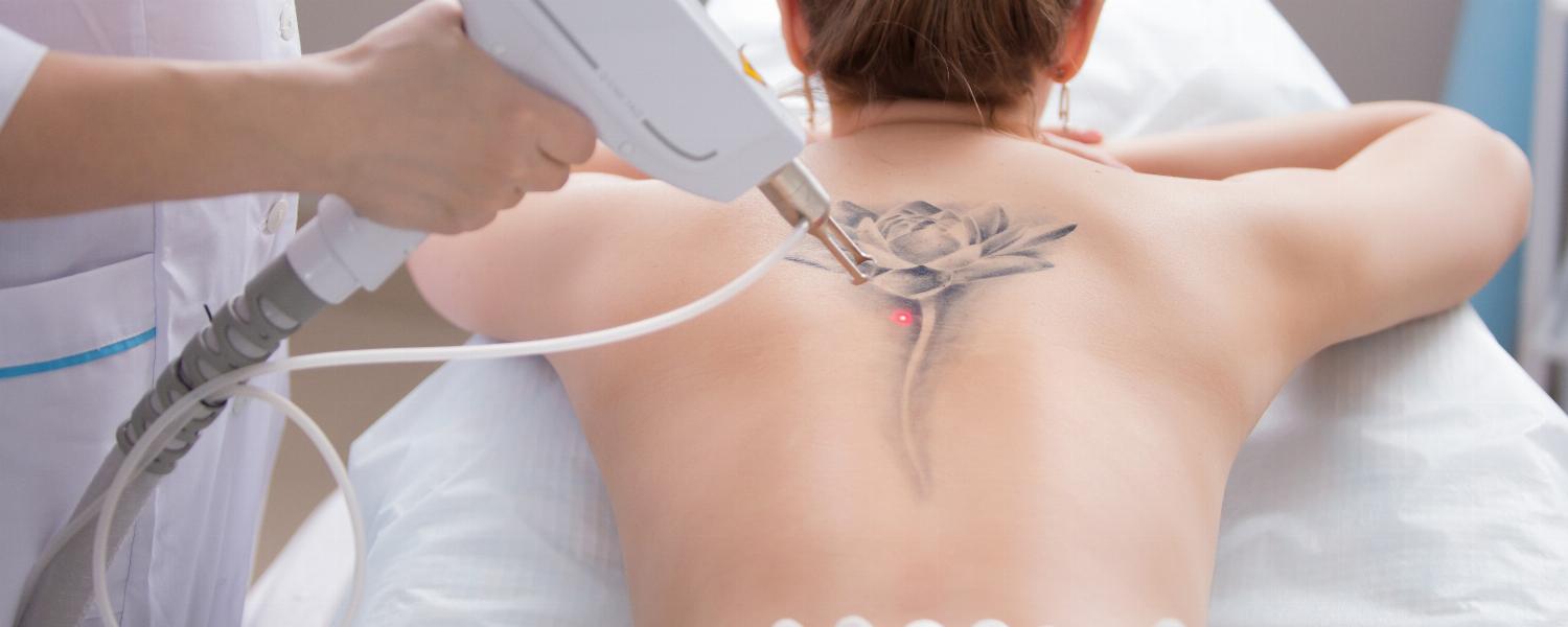 banner of Get Your Questions and Concerns About Tattoo Removal Answered
